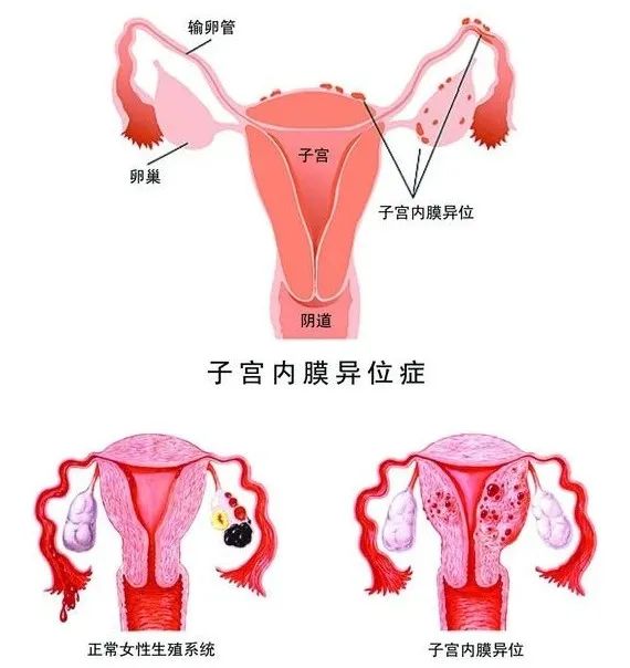 子宫内膜异位症会导致女性不孕吗,子宫内膜异位症只有剖腹产会有吗
