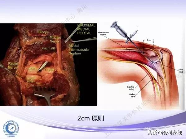肘关节镜手术后引流,肘关节镜微创手术
