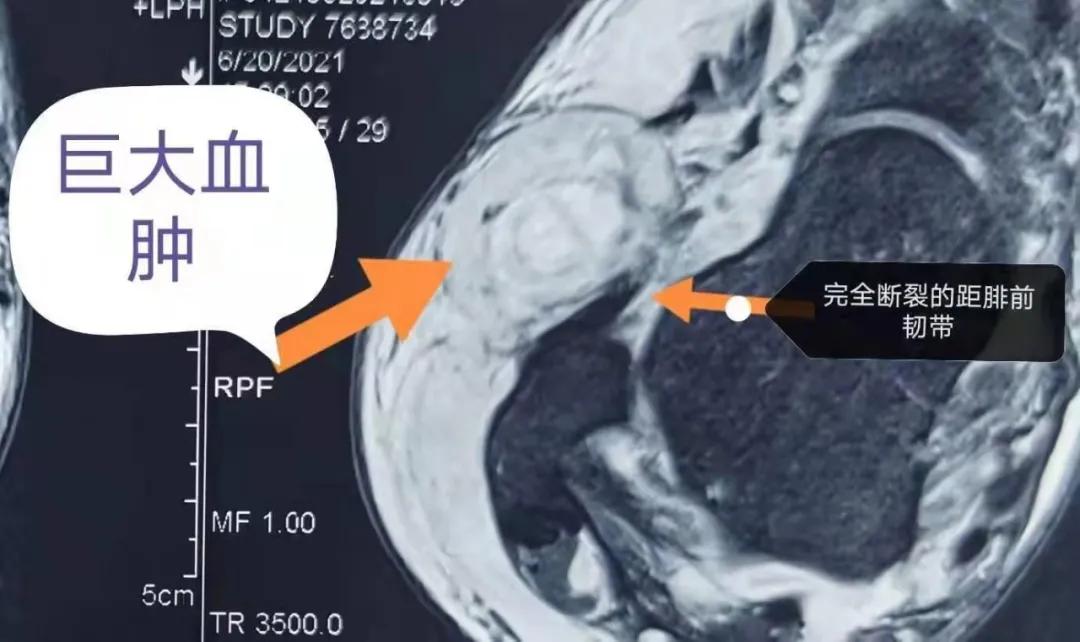 踝关节扭伤怎么判断骨头有没有伤,扭伤踝关节骨头移位去哪里治