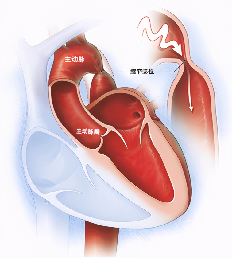 主动脉缩窄三联征,主动脉缩窄宝宝能要吗