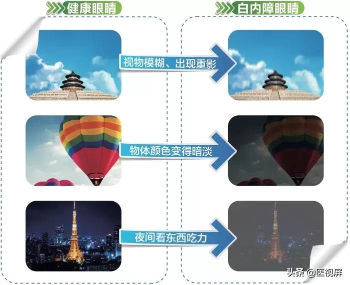 白内障不及时医治会加重近视吗,白内障不及时治疗会怎样