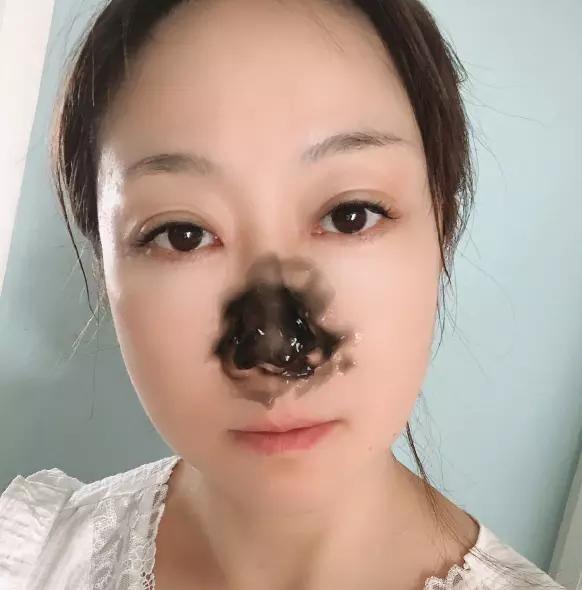 黑鼻头医生都不会告诉你的小妙招,鼻子油脂粒和黑鼻头的区别