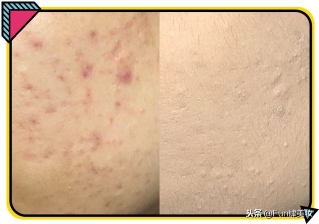 用粉底总是起皮用什么比较服帖,卡粉严重还是不化妆严重