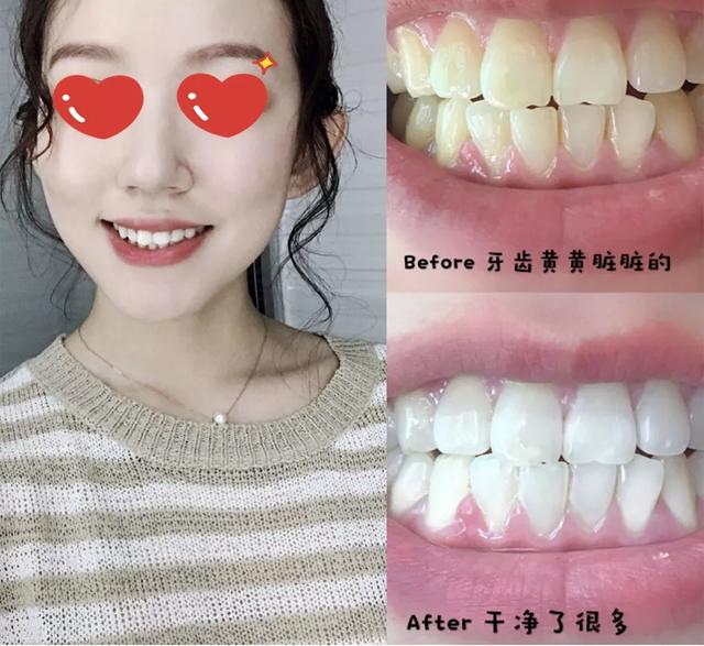 刷牙怎么刷能立刻从黄牙变成白牙,刷牙白牙小妙招