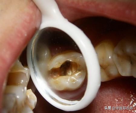 小孩蛀牙疼痛可以补牙吗,小孩蛀牙痛怎么缓解最有效