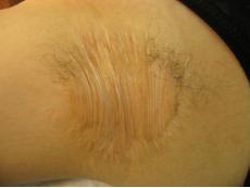 祛除腋臭,沈阳去除腋臭留下的疤痕