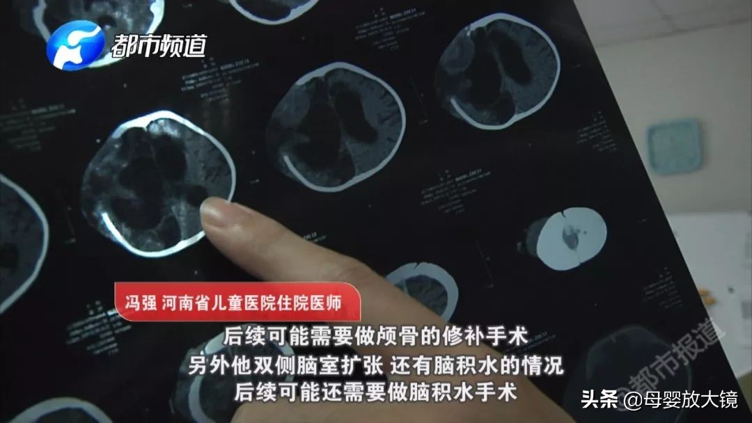 宝宝摔到头导致脑损伤,宝宝学走路摔了后脑