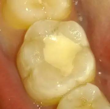 牙齿有银色充填物，需要注意什么？葉子口腔科普