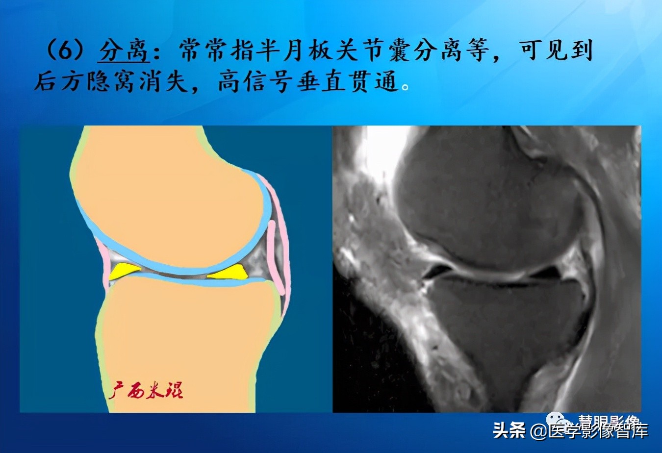 膝关节半月板损伤的解剖结构图,半月板mri解剖图解