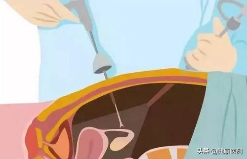 长期吃完饭就躺着的危害是什么,长期饮食油腻胆结石