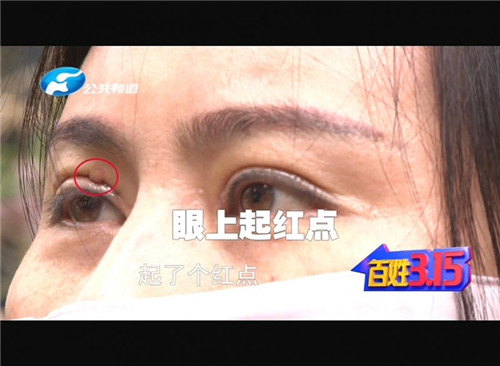 割双眼皮线没有拆干净出脓包了,郑州东方整形医院双眼皮成功案例