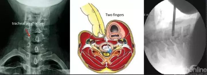 经皮腰椎间盘切除术有何优缺点,什么是经皮内镜腰椎手术