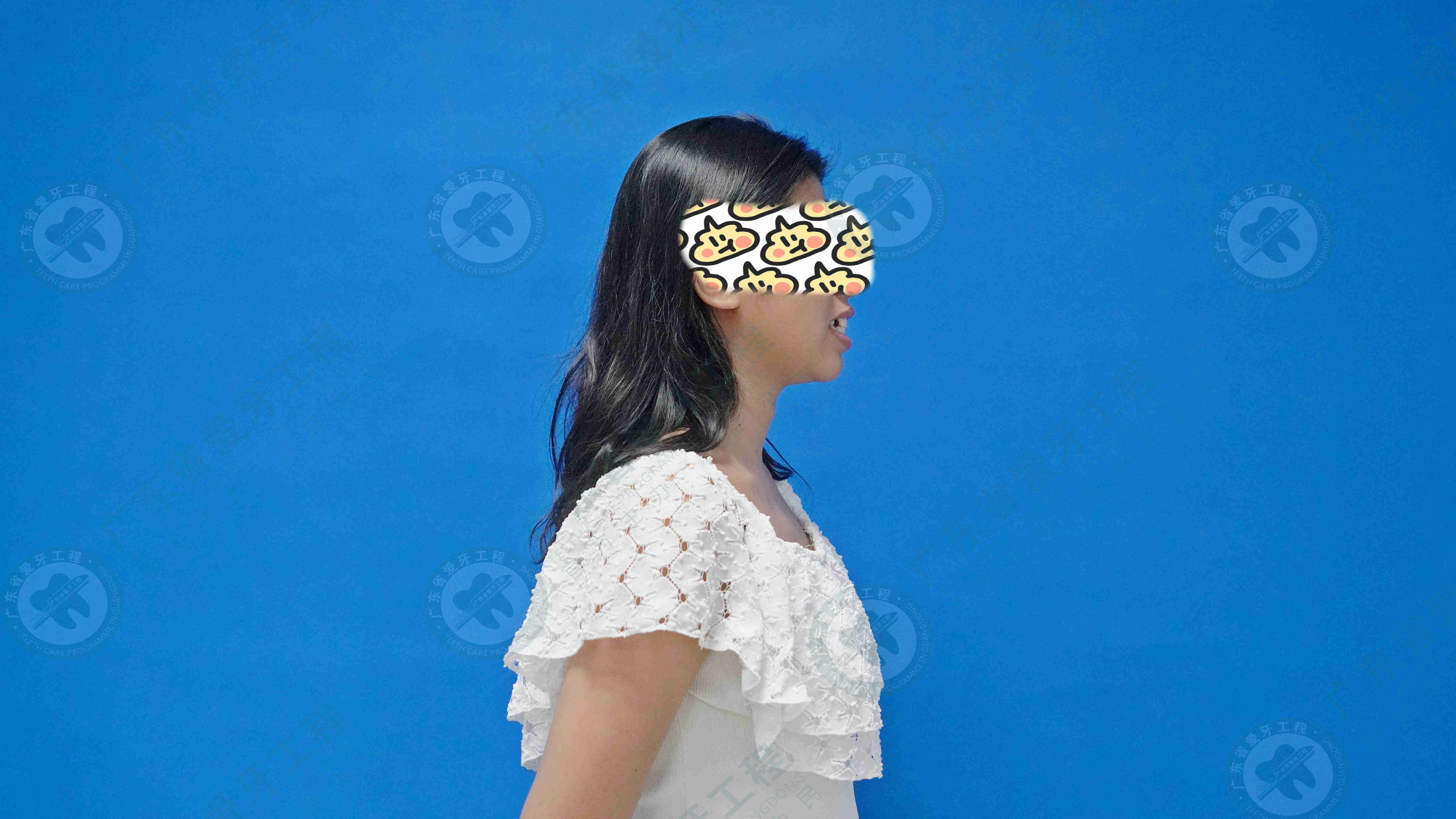 骨性龅牙凸嘴正颌手术全过程,29岁女生稍微骨性龅牙怎么矫正