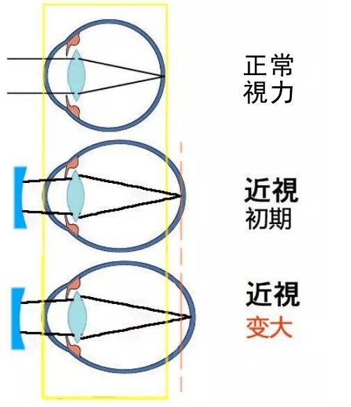 高度近视眼睛斗鸡眼怎么办,近视眼成斗鸡眼了怎么办