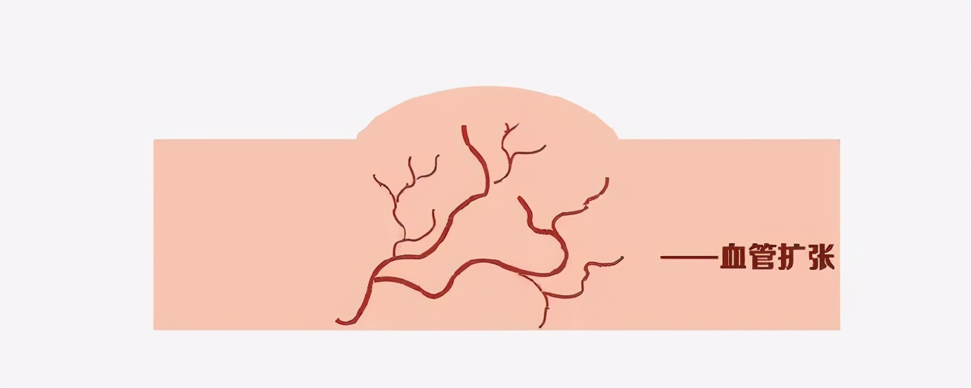 打软化针注意事项,瘢痕疙瘩软化针