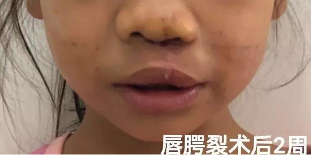 @儋州，赞！赞！赞！海南西部中心医院整复外科两例手术获好评