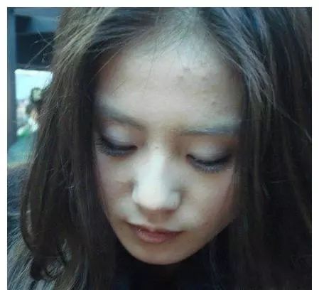 女星熬夜脸部痤疮,痘痘比较多的女明星