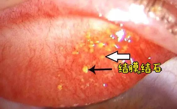 眼睛里长结石是什么原因,宝宝眼睛里面长结石
