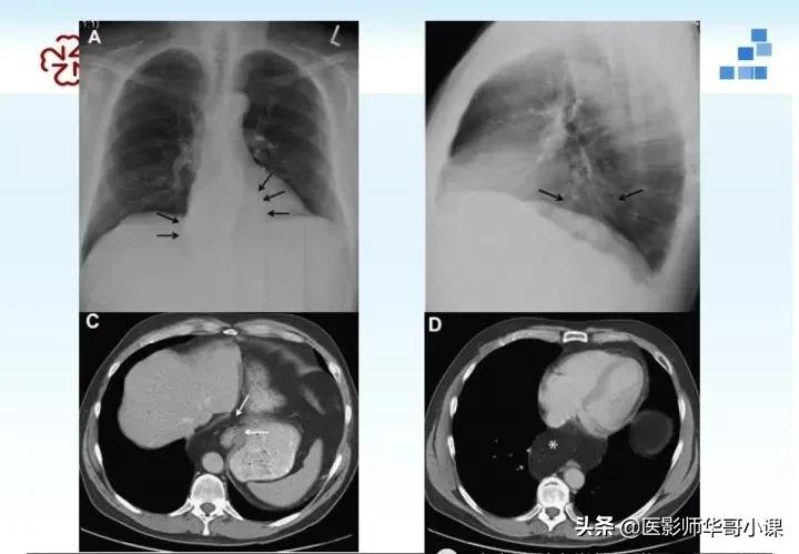 「精品课件」胸部膈肌的解剖及常见病变影像的表现