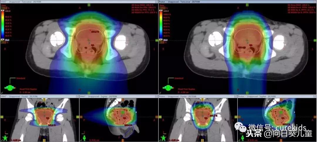 质子治肿瘤怎么样,儿童肿瘤质子治疗好吗