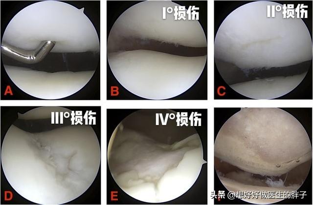膝盖怎样知道有骨刺,膝盖有骨刺中医怎么治