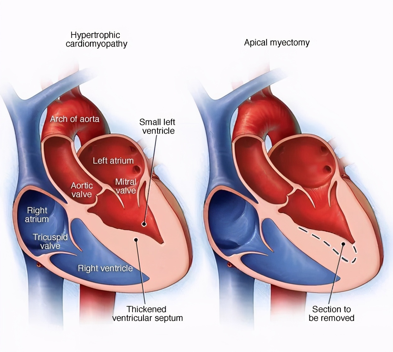 扩张型心肌病心衰是怎么回事,扩张型心肌病没什么症状