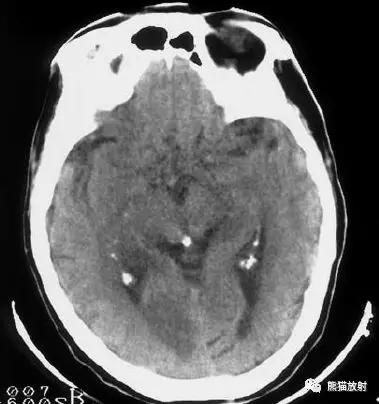 脑梗死丨演变、血供区域分布、CT表现