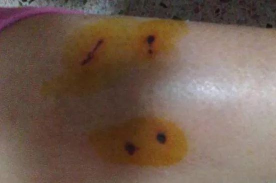 被仓鼠咬伤之后需要打疫苗吗,被仓鼠咬伤抓伤出血要打疫苗吗