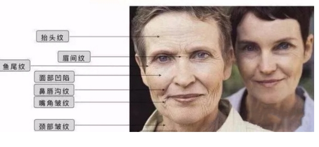 脸部皮肤松弛凹陷适合玻尿酸填充,脸部凹陷还下垂松弛做全脸填充吗