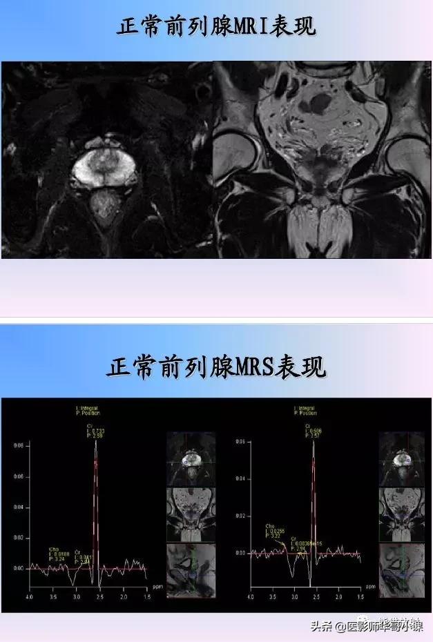 前列腺磁共振影像解剖,前列腺mri正常诊断报告模板