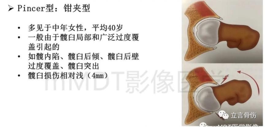 股骨髋臼撞击综合征吃哪些药呢,股骨髋臼撞击综合征做手术多少钱