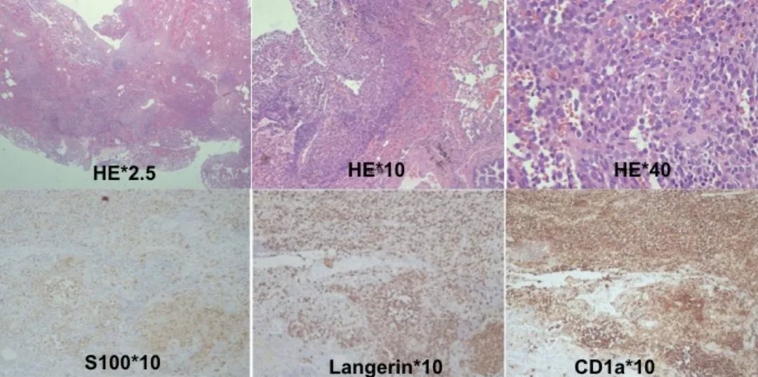 女性气胸的十大症状,女性气胸的十个表现