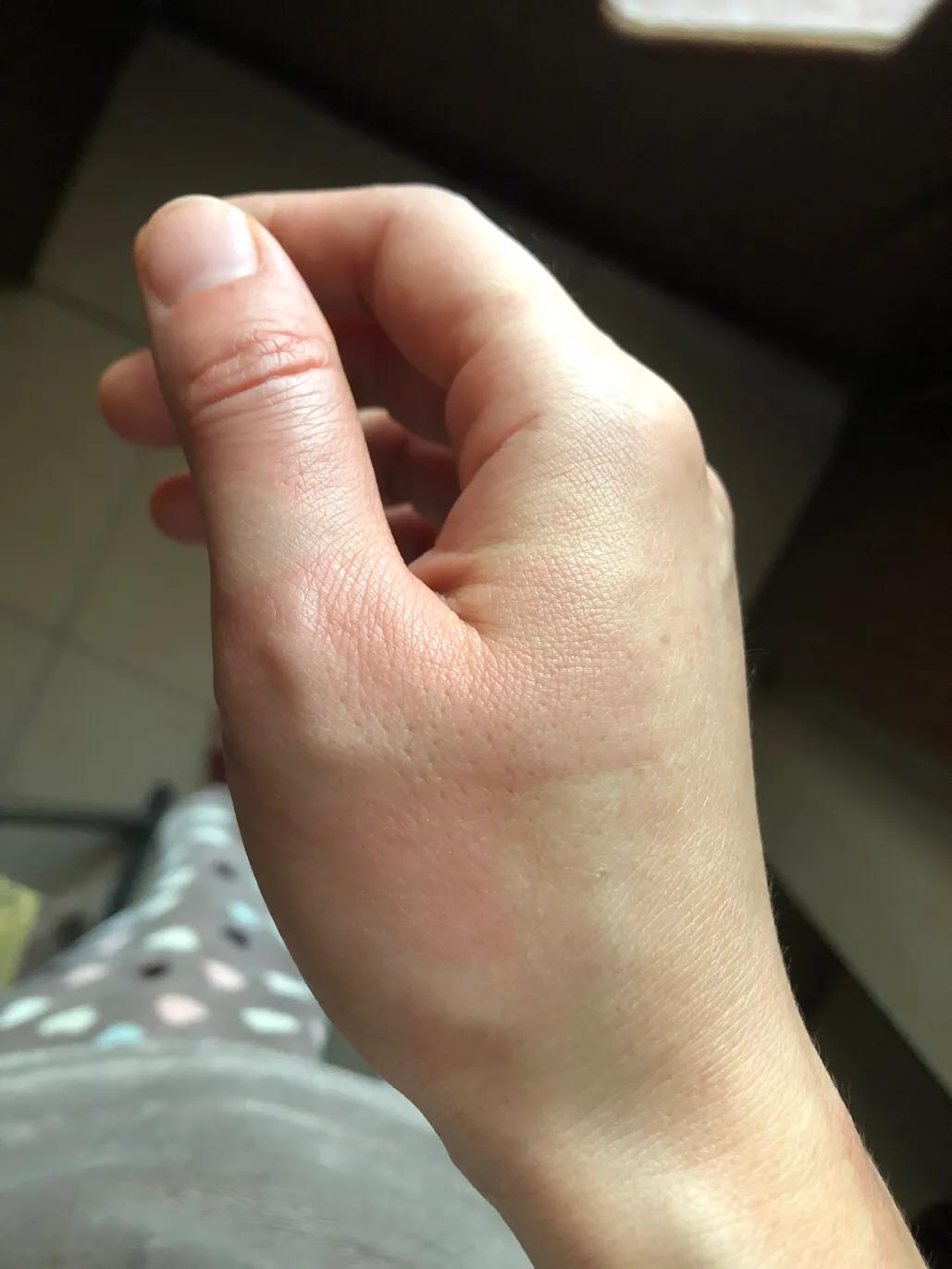 疫情期间低温烫伤的水泡怎么处理,烫伤后二十二天基本都平了