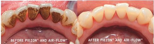 德州口腔医院洗牙团购,德州牙科整牙