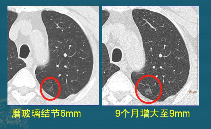 查出磨玻璃肺结节心里慌，该怎么做才保险？参考一下这6个