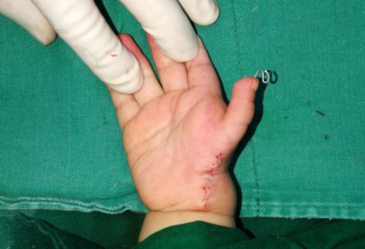 漂浮拇：成功保五指|案例5《左手多指右手漂浮拇，拇指成功搬家》