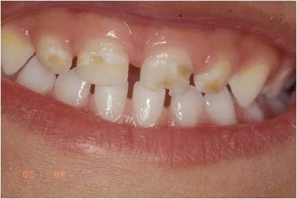 宝宝出牙口腔护理操作,宝宝出牙时期护理技巧大全