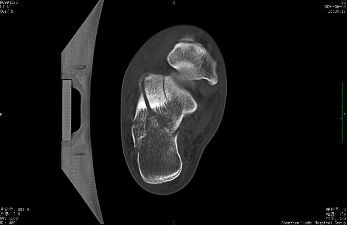 左股骨粗隆间粉碎性骨折微创手术,跟骨粉碎性骨折微创手术最快多久