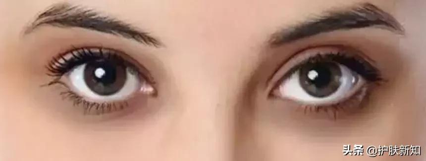 太有才了,竟然有人拿痔疮膏治疗黑眼圈