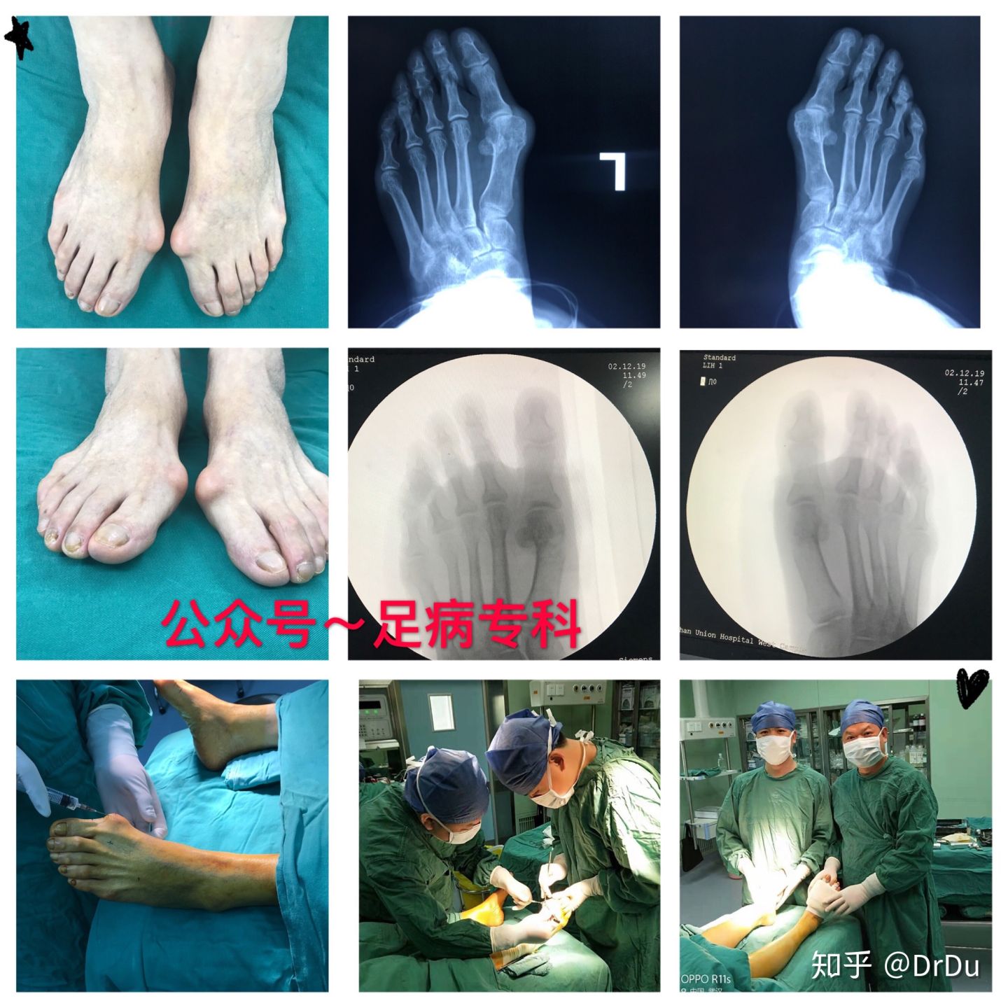 拇外翻微创手术的全过程,医生自己给自己做拇外翻手术