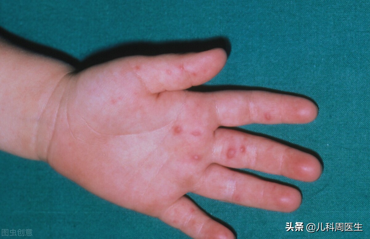 春季传染病向家长宣传,冬季传染病手足口病