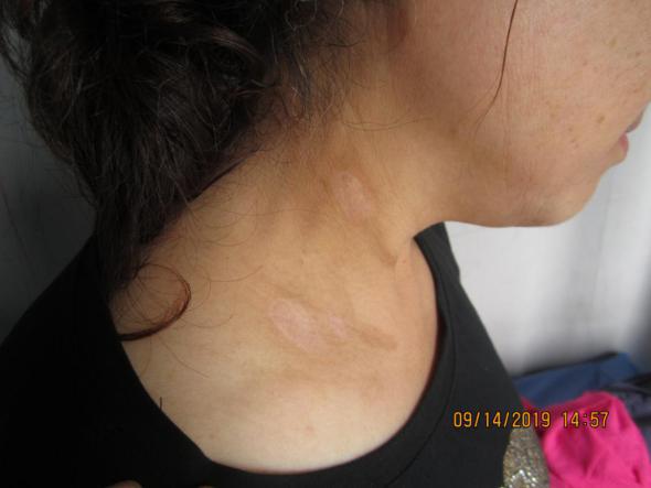 从确诊到康复，仅4个月，颈部白癜风患者王女士分享成功经验