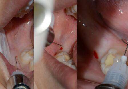个人拔牙要当心3个并发症,拔牙8颗有什么影响