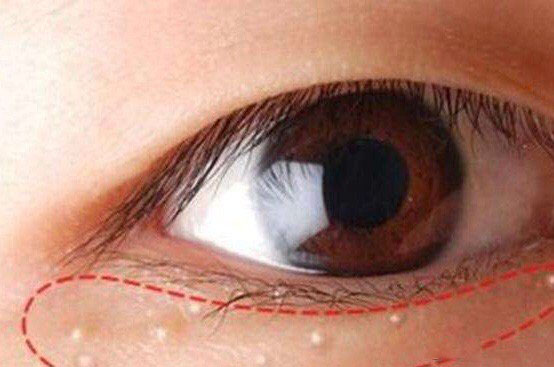 去眼部脂肪粒的最好方法,祛眼部脂肪粒最有效的方法