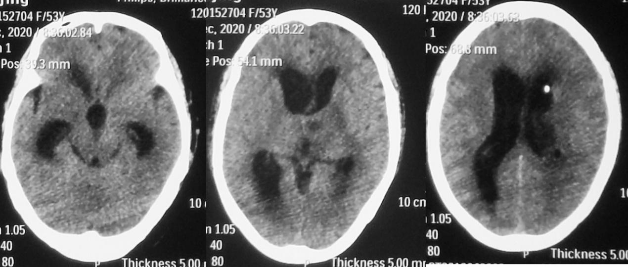 脑脓肿合并脑膜炎需要手术吗,脑脓肿进入左侧脑室严重吗