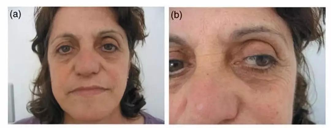 黑眼圈只是熬夜,熬夜狠了怎么拯救黑眼圈