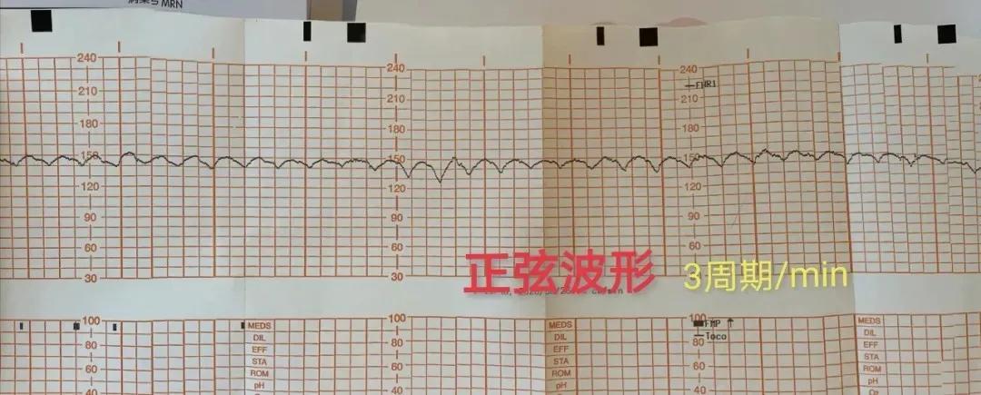 产妇胎心骤降胎儿命悬一线,产妇胎儿宫内窘迫抢救措施