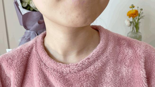 谁说野火烧不尽,战痘经验值万金