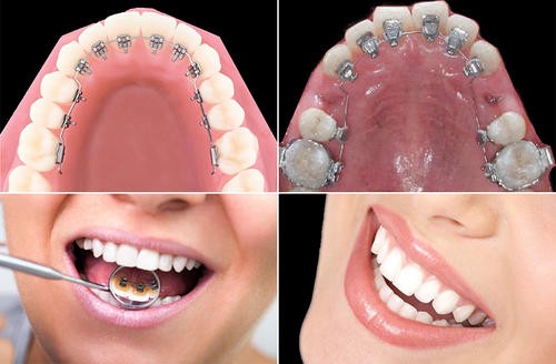 矫正牙齿矫治器有哪些,牙齿矫正矫治器有哪几种