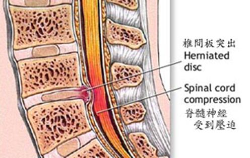 吸烟引起的左侧颈部疼痛,吸烟导致慢性病吗